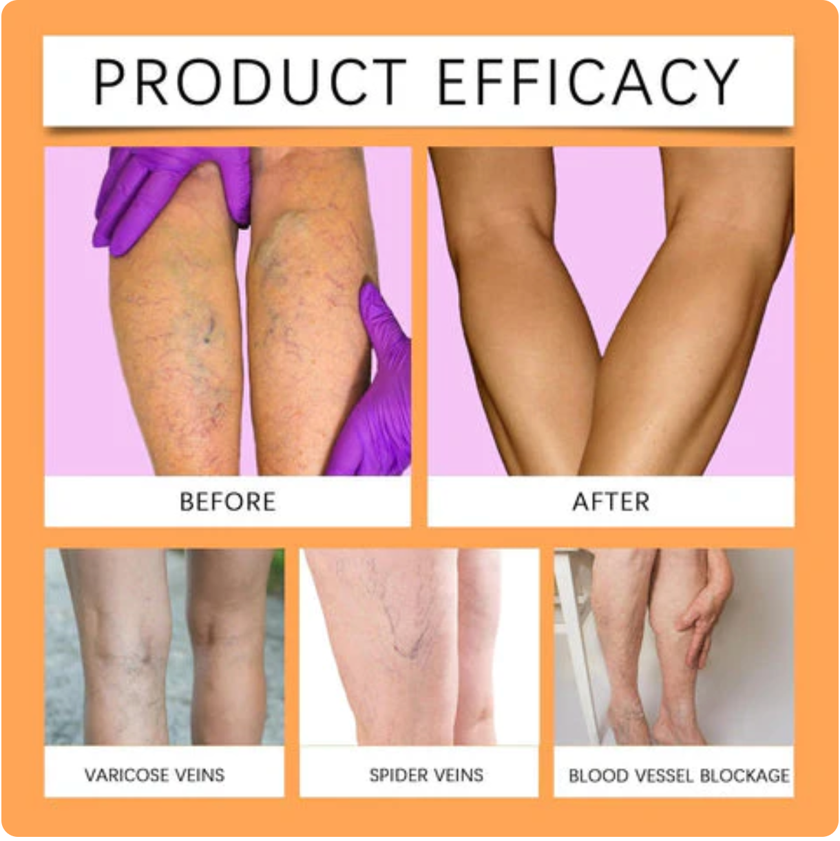 Varicose Veins Relief Herbal Spray - (Buy 1 Get 1 FREE🔥🔥)